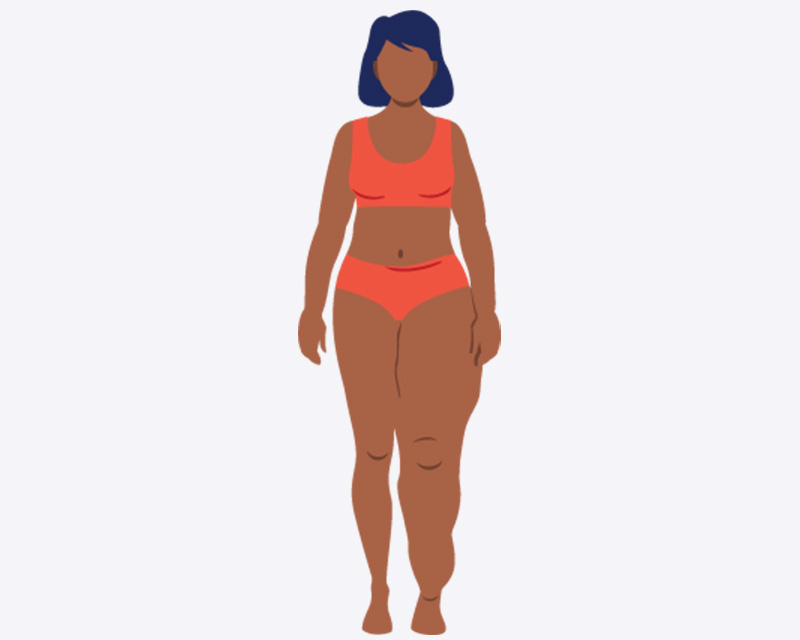 Illustration of a woman with lymphoedema, showing visible swelling and deformity in one leg. Illustration of a woman with lymphoedema, showing visible swelling and deformity in one leg.